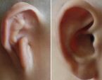 耳廓手术效果
