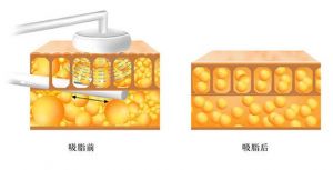 www.51aimei.com提供的安徽韩美整形吸脂技术图