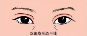 田国静医生是郑州双眼皮修复比较好的医生