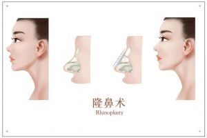 南京做肋骨鼻子自然、技术好的医生推荐