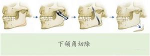 下颌角切除手术过程51aimei.com
