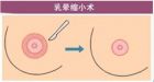 乳晕缩小整形术