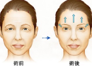 全面部拉皮除皺手術