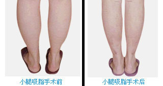 小腿吸脂前后对比图