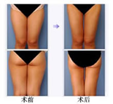 大腿吸脂手术前后对比图