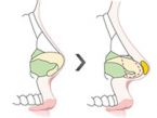 短鼻延长术