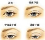 眼睑下垂