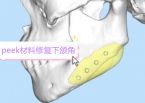 peek材料修复下颌角