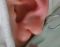 耳垂裂修复手术