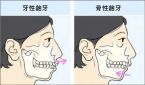 医生不建议做正颌手术的原因