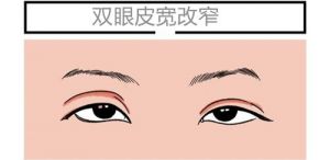上海陈红梅双眼皮修复实例