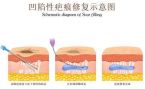 广州面部凹陷疤痕修复医院排名