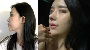 韩国优雅人肋骨鼻修复前后对比图
