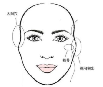 一针降颧骨手术