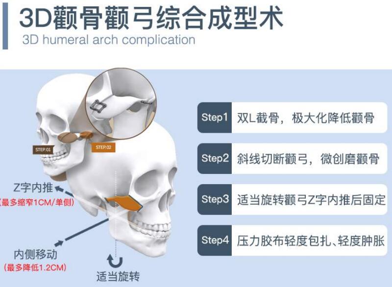 上海华美颧骨内推技术优势