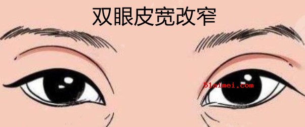 上海美莱吴海龙双眼皮修复真的靠谱,做的双眼皮宽改窄修复实例能证实