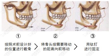 51aimei.com分享下巴截骨前移手术操作步骤图解