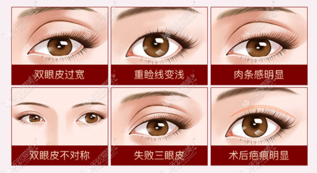 www.51aimei.com杜园园修复双眼皮怎么收费