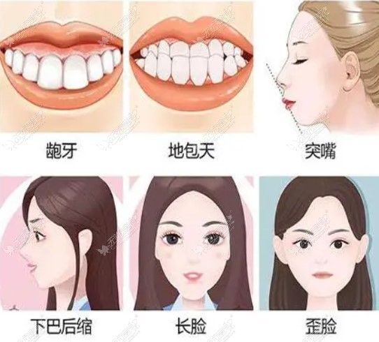 广州正颌手术排名前三医院改善脸型症状无忧爱美网