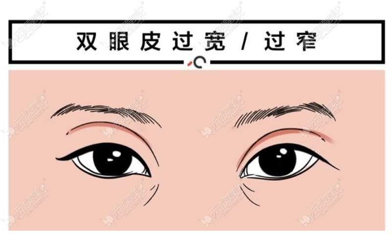 西安孙峰修复双眼皮价格