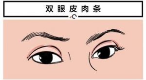 刘志刚医生修复肉条眼方法