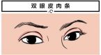 尹度龙双眼皮修复评价及示例