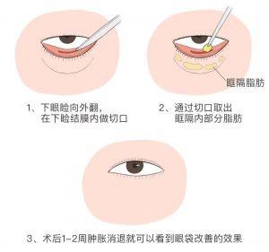 内切祛眼袋手术方式