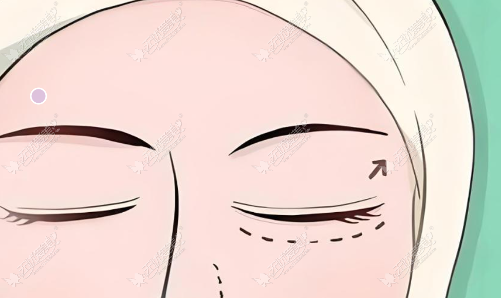 上海双眼皮手术哪家医院比较好 上海双眼皮手术哪家医院比较好