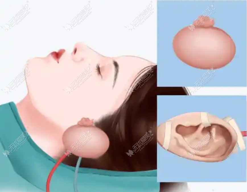 上海耳再造一期多少钱