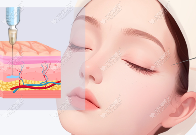 核心解答:脸上打轻薄针几天出成效? 核心解答:脸上打轻薄针几天出成效?