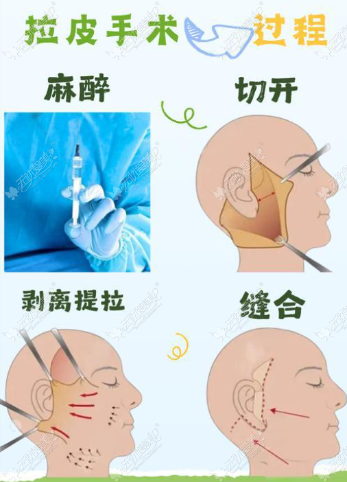 黄寅守拉皮全过程 黄寅守拉皮全过程