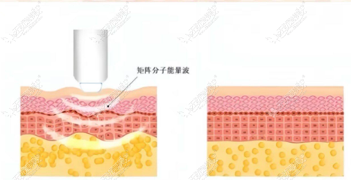 做热玛吉的好处和坏处