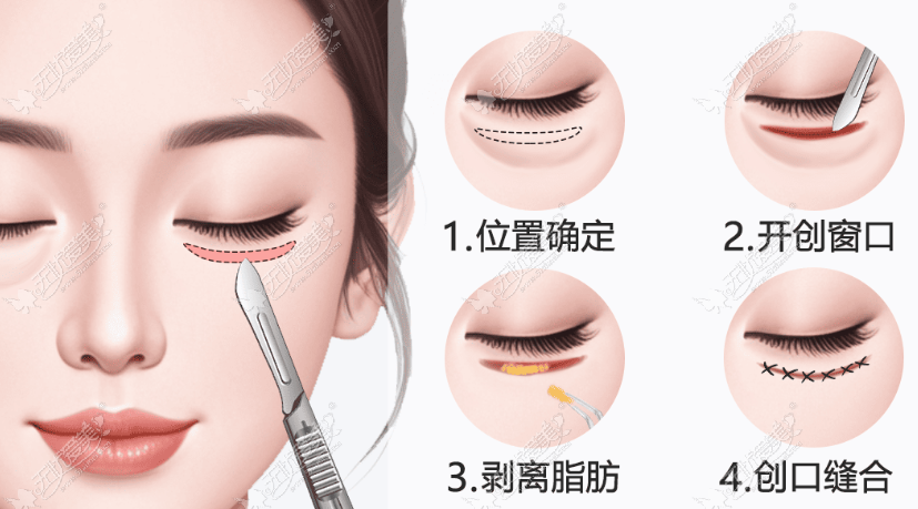 珠海王倜割眼袋价格究竟是多少？明细全解析