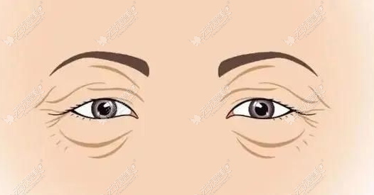 揭秘健丽美诗沁不开刀去眼袋技术:看去眼袋方式适不适合你