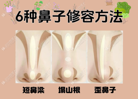 南京做假体失败修复找林金德靠不靠谱？假体歪斜透光能不能解决？