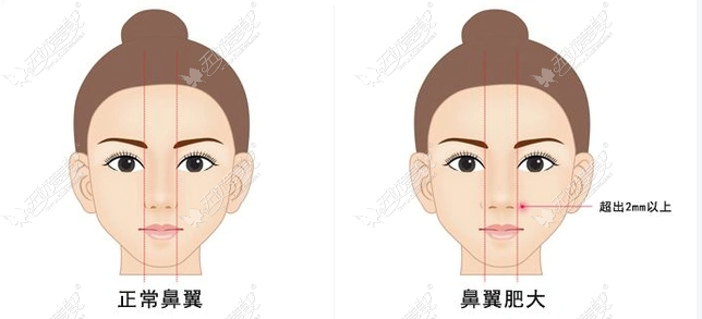 重庆谢锦清鼻综合：美卫士专属预约通道开启！看懂3.0技术换代，抢先锁定手术档期