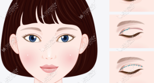 于医生眼袋手术口碑和消肿速度怎么样?打开美卫士App看中老年及年轻人眼部减龄案例