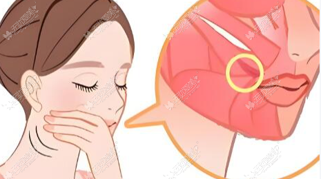 何才伟医生轮廓手术恢复多久能出门？术后消肿及吃东西指南