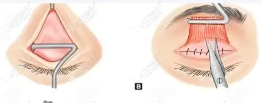 何康医生双眼皮手术真实案例分享:网感妈生眼是怎样炼成的?
