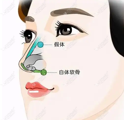 太原陈柳艺做鼻子如何 太原陈柳艺做鼻子如何