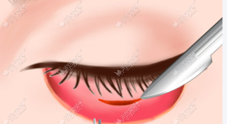 刘宝龙祛眼袋术后半年真实状态，美卫士用户复诊反馈告诉你！