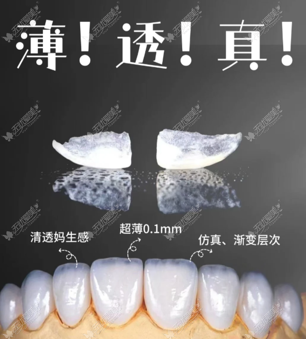北京做 16 颗瓷贴面多少钱？国产 / 进口材质价格对比，上贝色查询门店底价