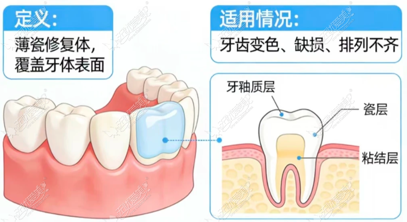 南京牙贴面价格多少钱一颗？单颗500元起，全口16颗不到1万能做全瓷贴面还送微笑线设计，去贝色查各牙科全口贴面套餐价
