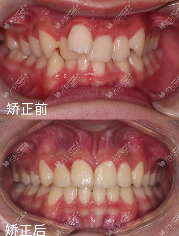 在广州高考完想正畸，医院怎么选？上贝色直接查底价+看地址（附预约攻略）