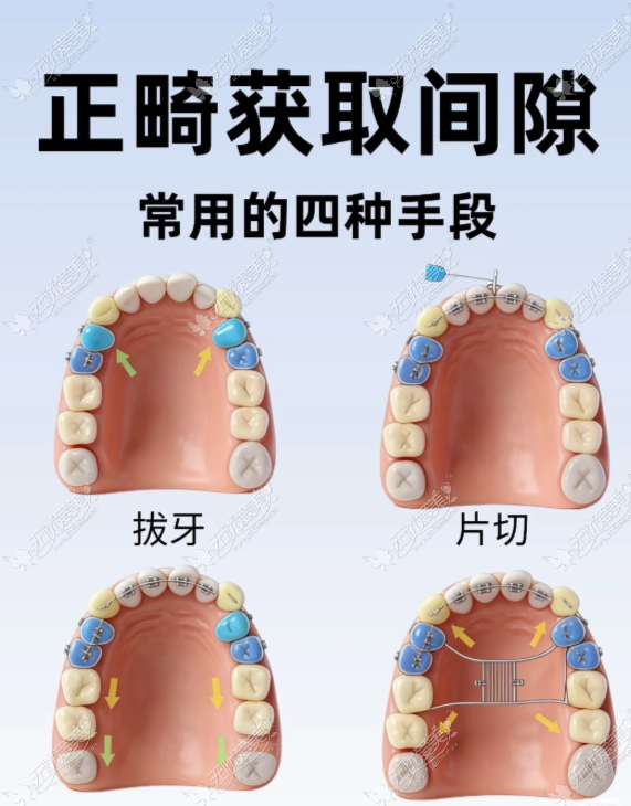 天津牙齿矫正全包账单、费用明细与避坑指南（附真实 23800 元正畸案例）